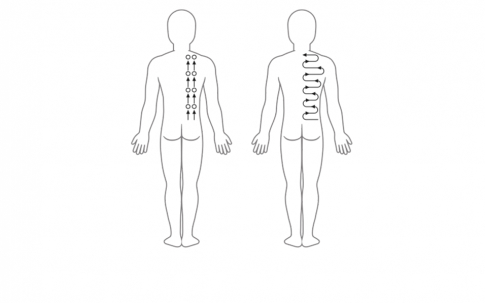 Cupping lichaam