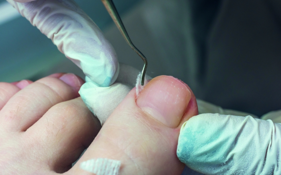 Ingegroeide teennagel: oorzaken, behandeling en preventie